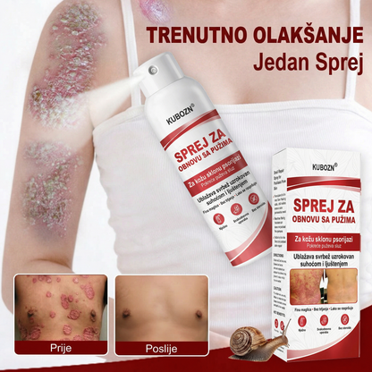 KUBOZN® 🎉SPREJ ZA OBNOVU SA PUZIMA za svrbežnu, perutavu kožu kod psorijaze 🎁