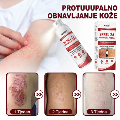 KUBOZN® 🎉SPREJ ZA OBNOVU SA PUZIMA za svrbežnu, perutavu kožu kod psorijaze 🎁